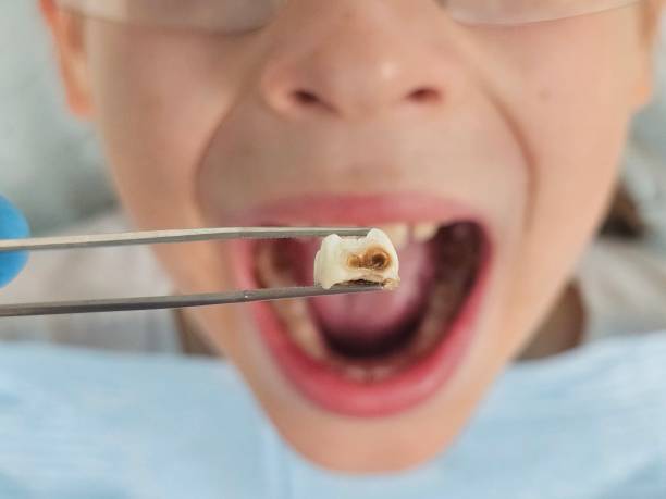 Best Dentist for Tooth Abscess  in Sauk Vlage, IL